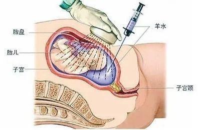 四个月引产是否需要清宫，深度解析与指导